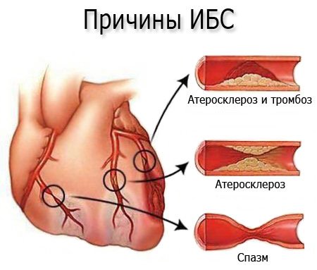 Ишемическая болезнь сердца (ИБС) – симптомы, причины, виды и лечение ИБС